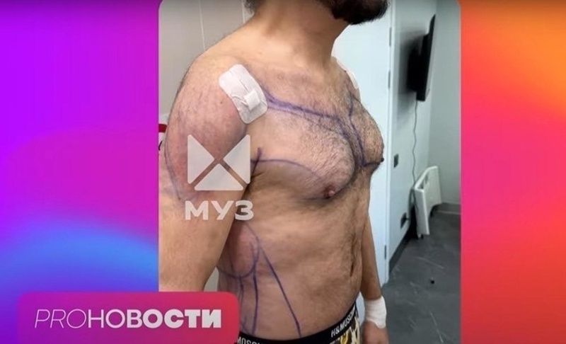 Певец сделал липосакцию