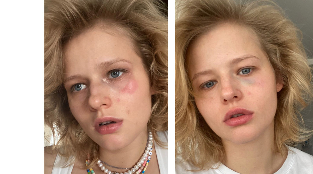 В день 28-летия Александра Бортич получила сильный удар в глаз